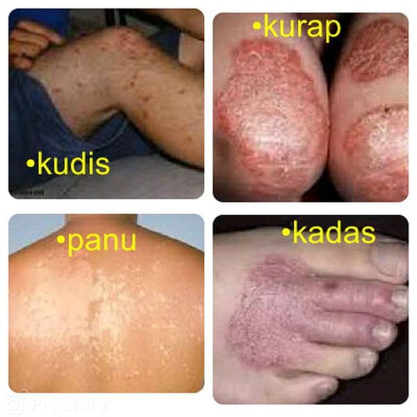 Detail Gambar Kudis Dan Kurap Nomer 2