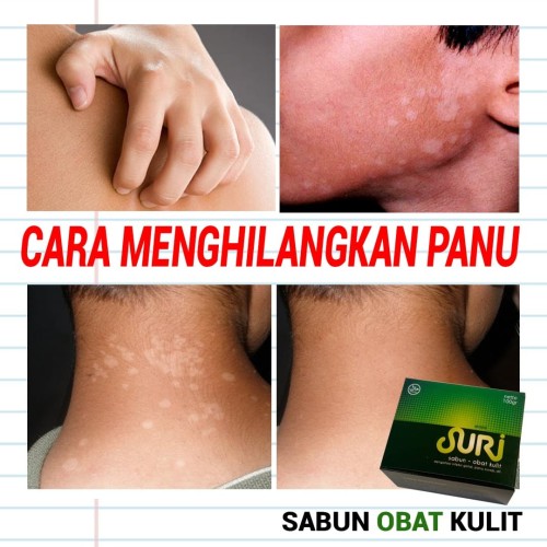 Detail Gambar Kudis Dan Kurap Nomer 57