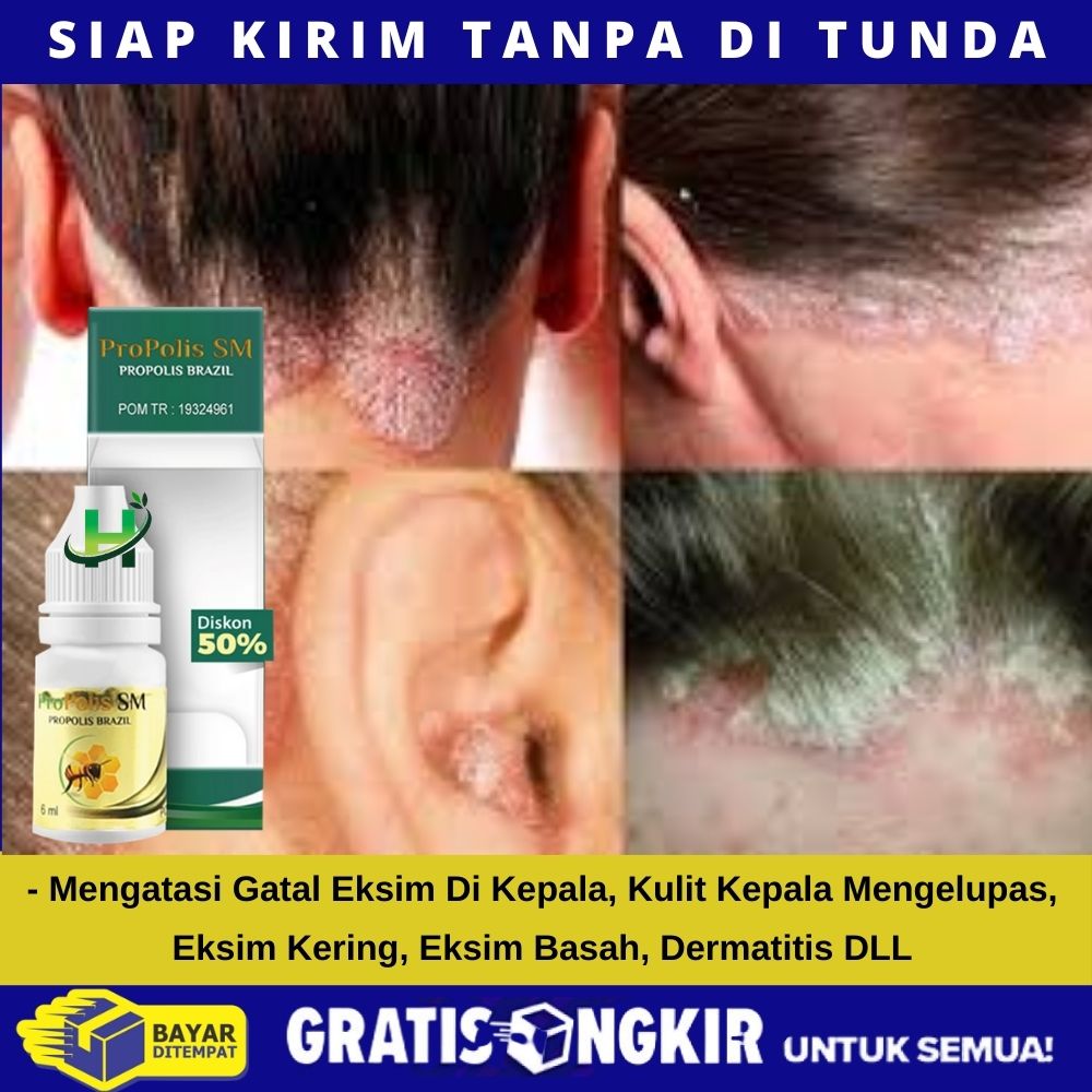 Detail Gambar Kulit Eksim Kering Nomer 45