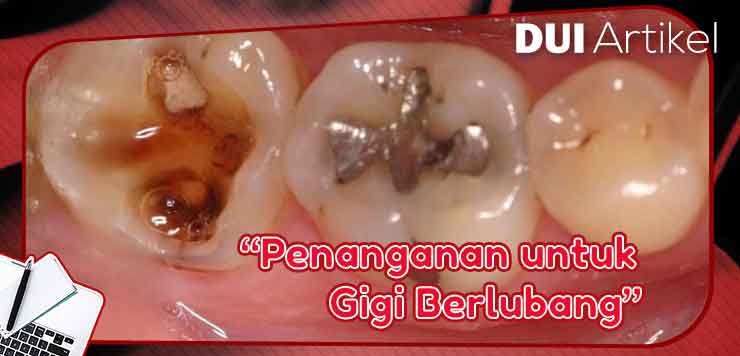 Detail Gambar Kuman Gigi Berlubang Nomer 28