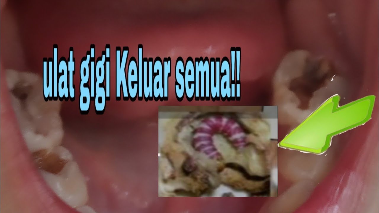 Detail Gambar Kuman Gigi Berlubang Nomer 7