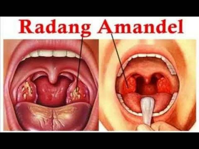 Detail Contoh Radang Tenggorokan Nomer 12