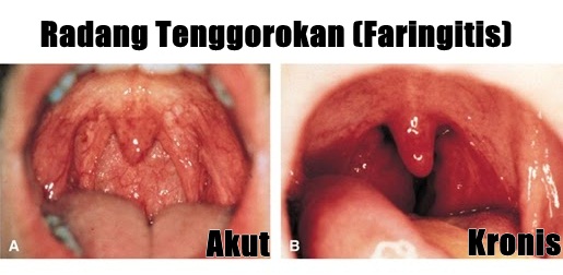 Detail Contoh Radang Tenggorokan Nomer 51