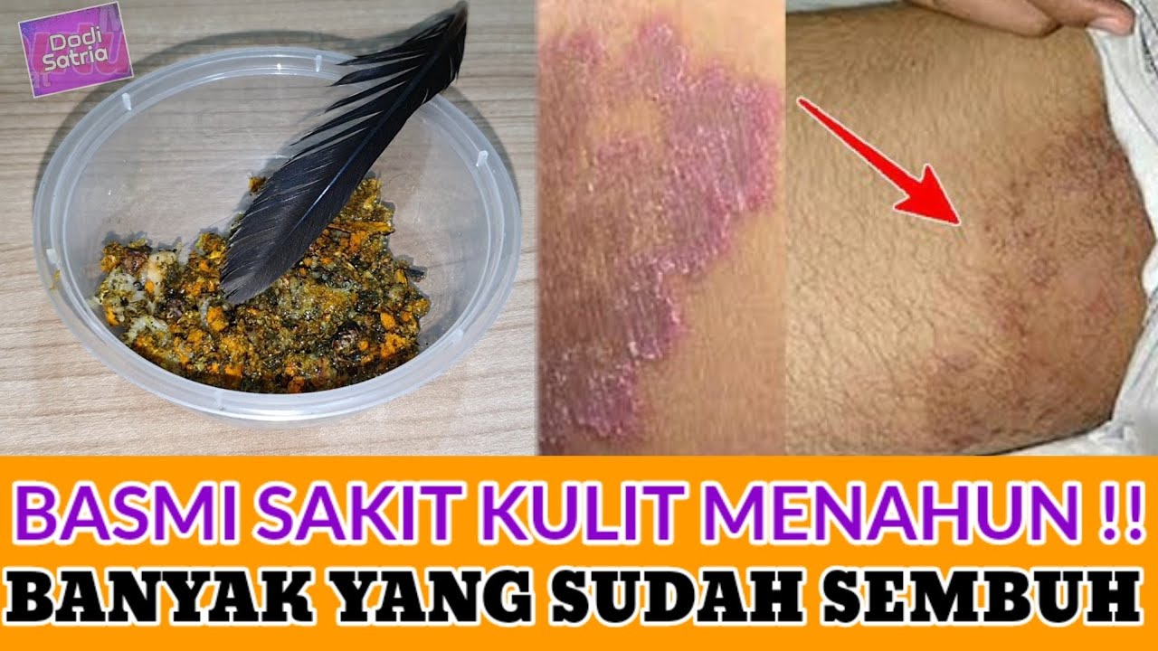 Detail Gambar Kurap Yang Sudah Sembuh Nomer 33