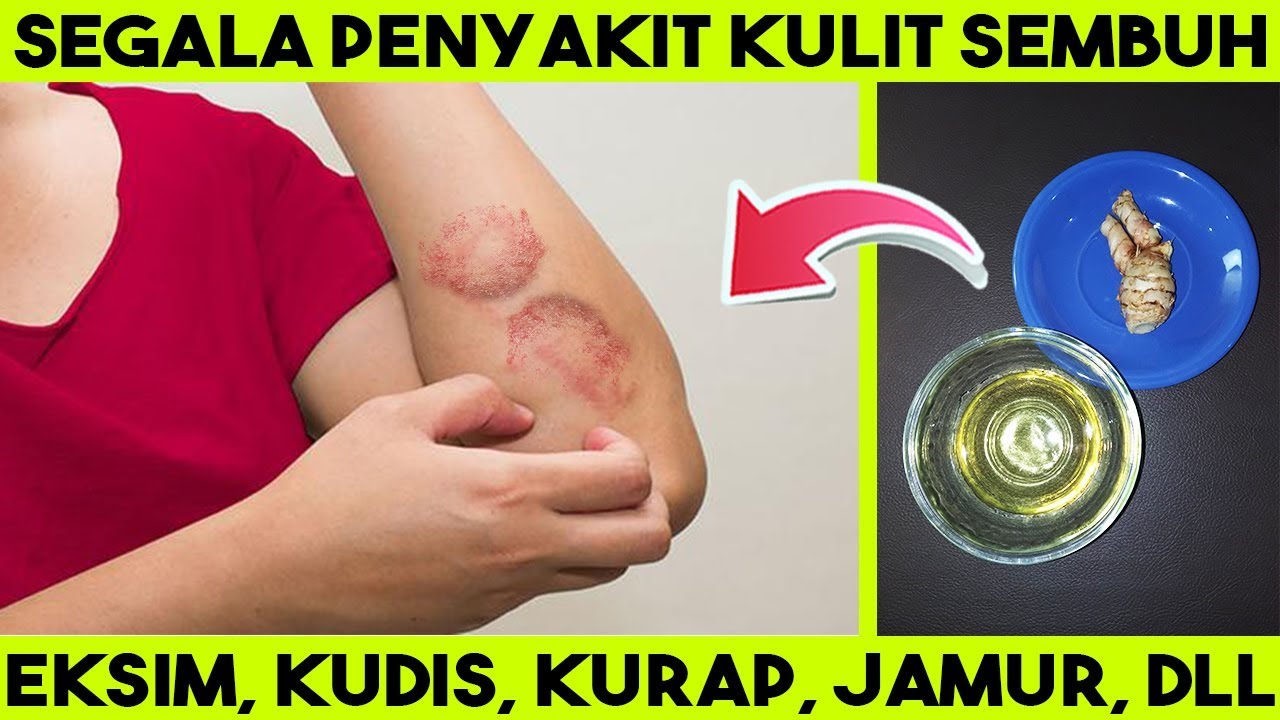 Detail Gambar Kurap Yang Sudah Sembuh Nomer 39