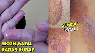 Detail Gambar Kurap Yang Sudah Sembuh Nomer 7