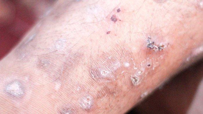 Detail Gambar Kutu Scabies Nomer 19