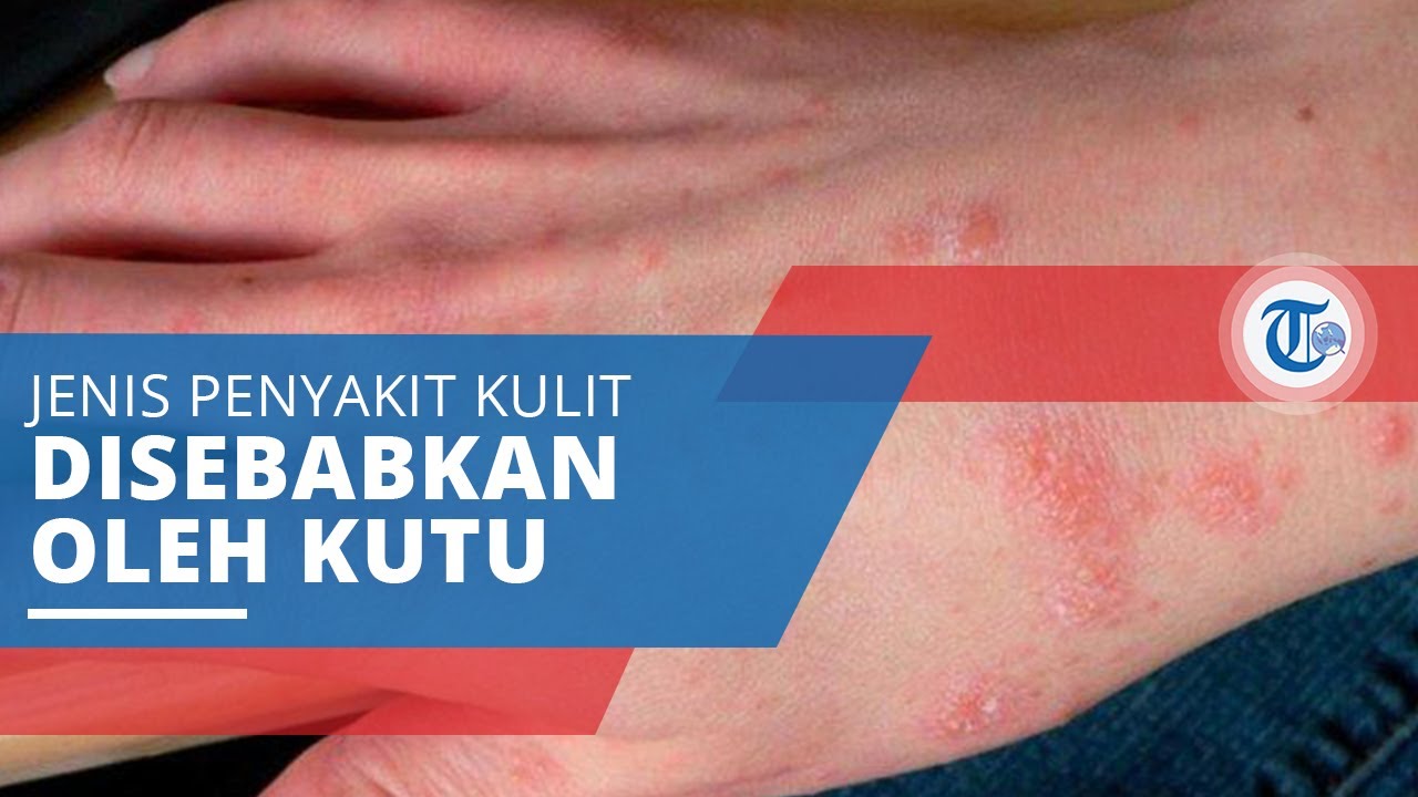 Detail Gambar Kutu Scabies Nomer 34