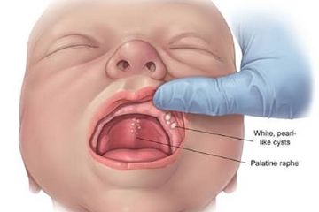 Gambar Langit Langit Mulut Bayi - KibrisPDR