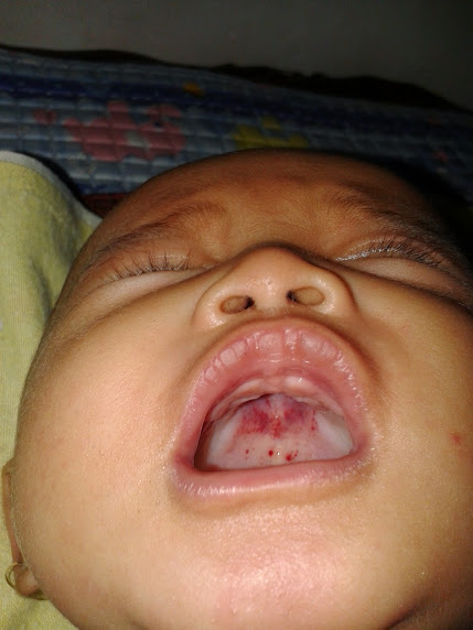 Detail Gambar Langit Langit Mulut Bayi Nomer 17