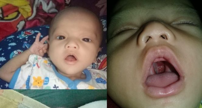 Detail Gambar Langit Langit Mulut Bayi Nomer 21