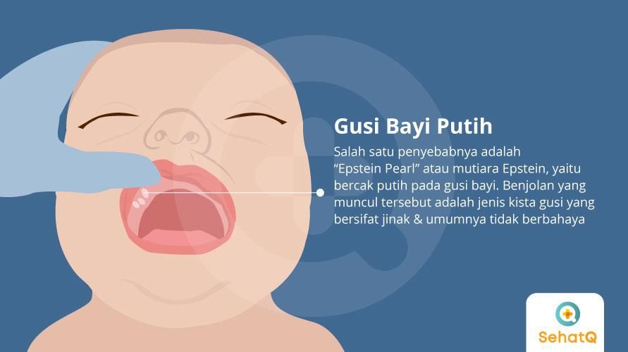 Detail Gambar Langit Langit Mulut Bayi Nomer 41