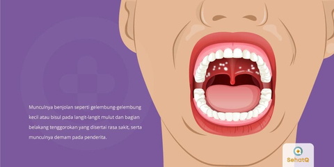 Detail Gambar Langit Langit Mulut Yang Sehat Nomer 14