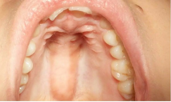 Detail Gambar Langit Langit Mulut Yang Sehat Nomer 18