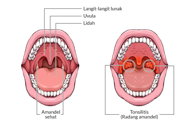 Detail Gambar Langit Langit Mulut Yang Sehat Nomer 25