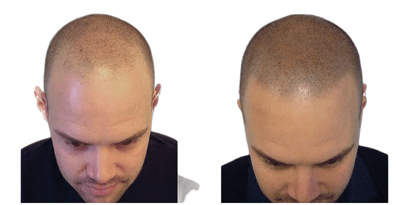 Detail Buzz Cut Mit Bart Nomer 6