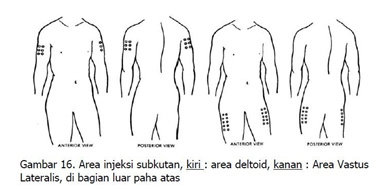 Detail Gambar Lokasi Injeksi Intramuskular Nomer 34