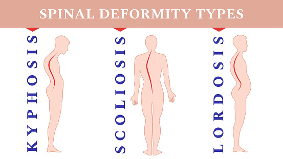 Detail Gambar Lordosis Kifosis Dan Skoliosis Nomer 33