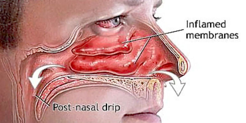 Detail Gambar Lubang Hidung Normal Nomer 33