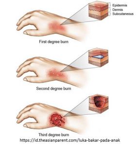 Detail Gambar Luka Bakar Nomer 14