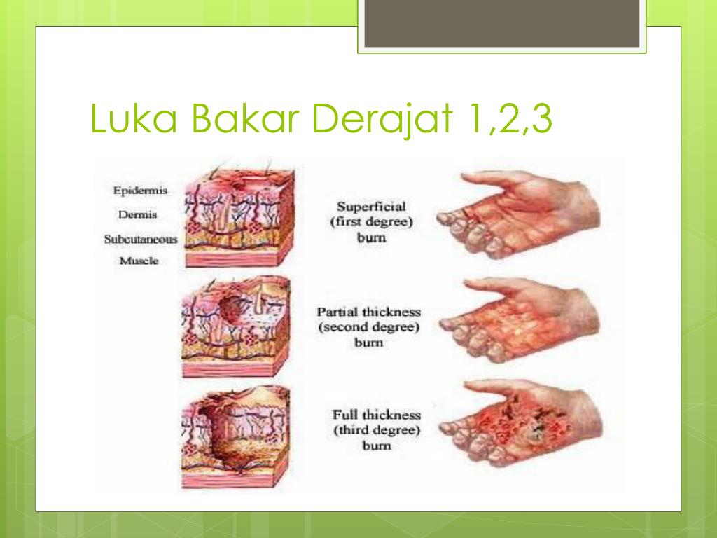 Detail Gambar Luka Bakar Derajat 1 2 3 Nomer 12