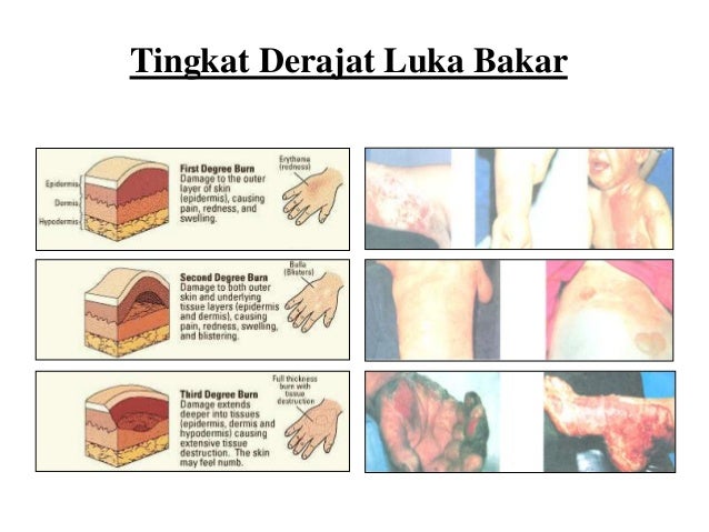 Detail Gambar Luka Bakar Derajat 1 2 3 Nomer 13