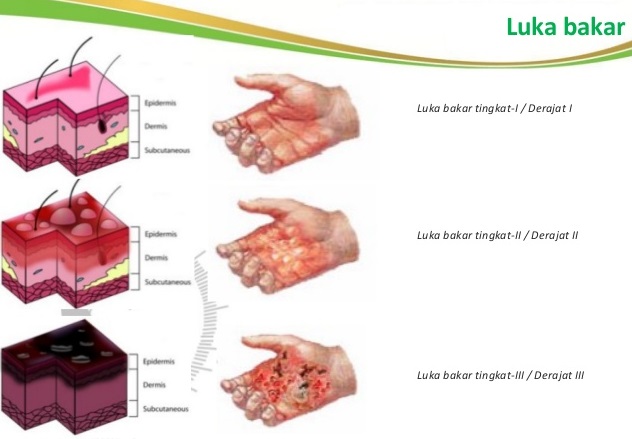 Detail Gambar Luka Bakar Derajat 1 2 3 Nomer 14