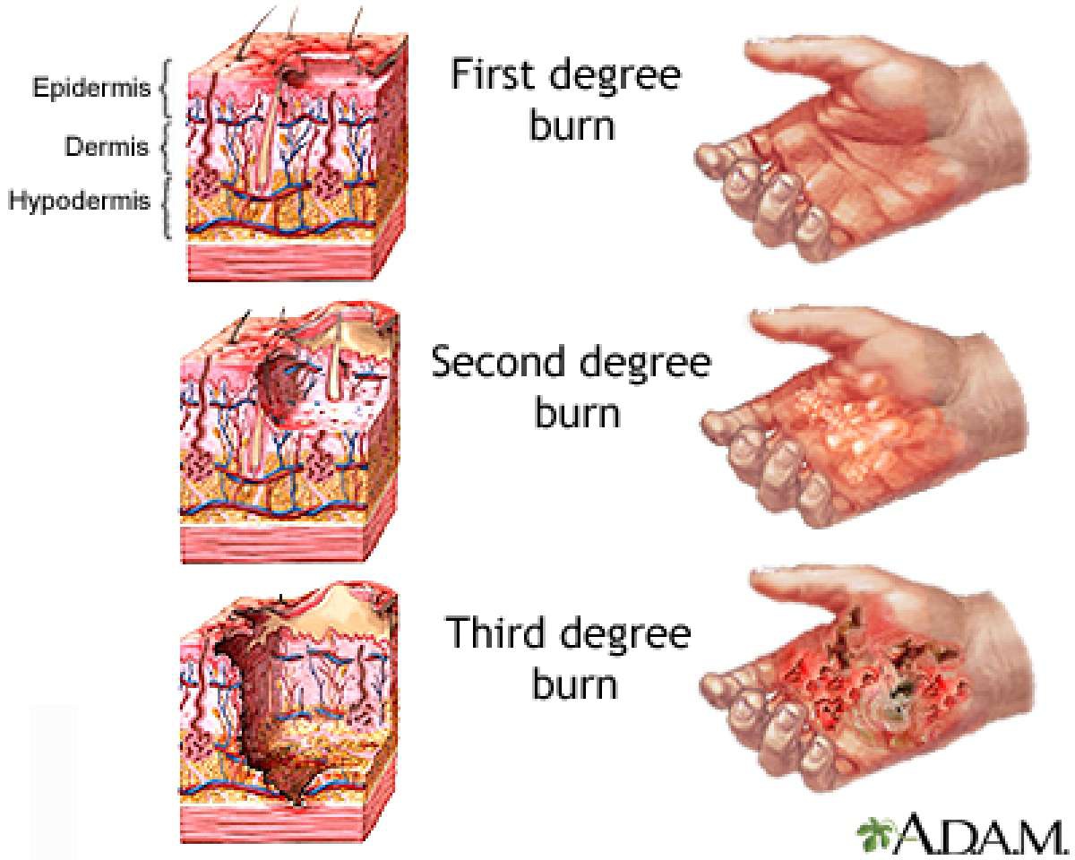 Detail Gambar Luka Bakar Derajat 1 2 3 Nomer 17
