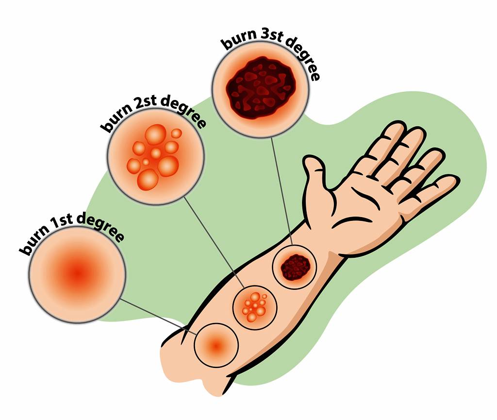Detail Gambar Luka Bakar Derajat 1 2 3 Nomer 18
