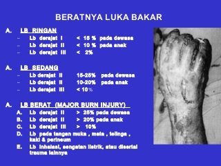 Detail Gambar Luka Bakar Derajat 1 2 3 Nomer 35