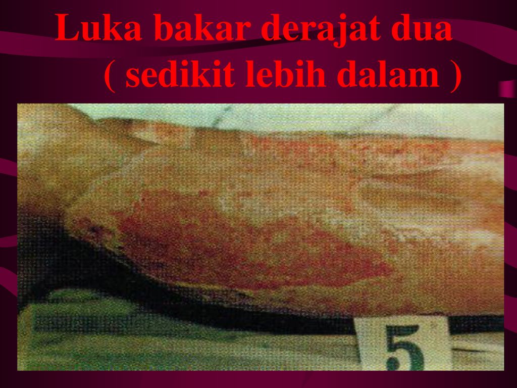 Detail Gambar Luka Bakar Derajat 1 2 3 Nomer 42