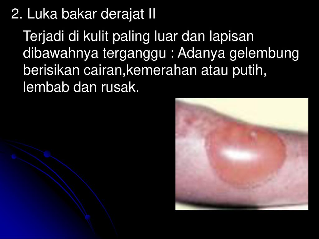 Detail Gambar Luka Bakar Derajat 2 Nomer 53