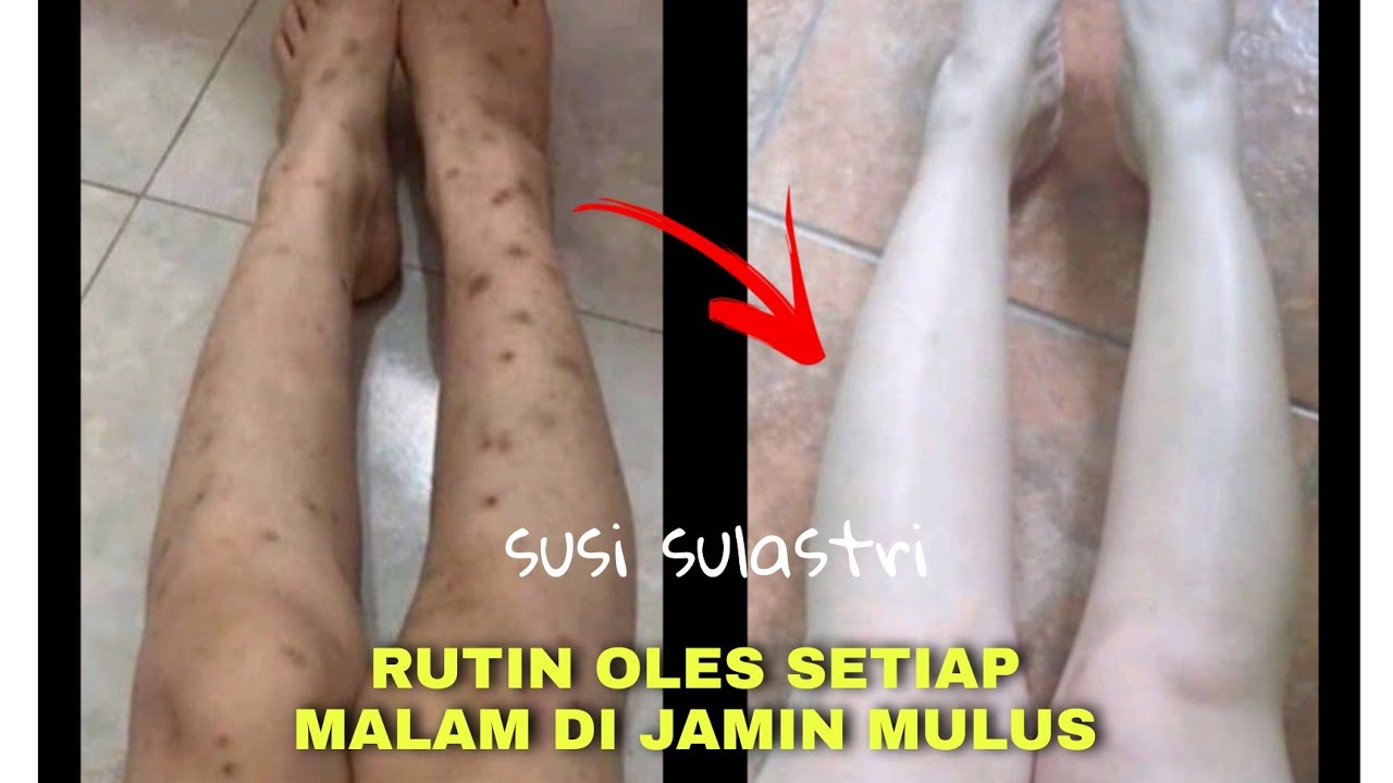 Detail Gambar Luka Di Kaki Nomer 46