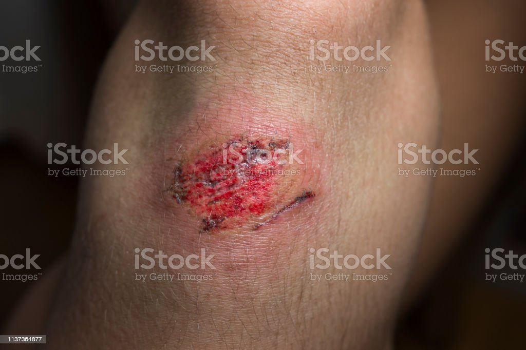 Detail Gambar Luka Di Lutut Nomer 25
