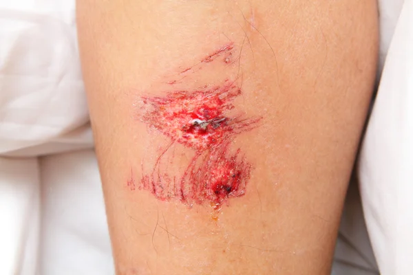 Detail Gambar Luka Di Lutut Wanita Nomer 15