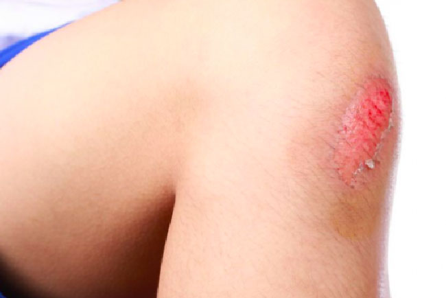 Detail Gambar Luka Di Lutut Wanita Nomer 24