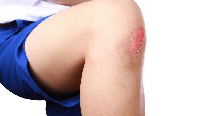 Detail Gambar Luka Di Lutut Wanita Nomer 39