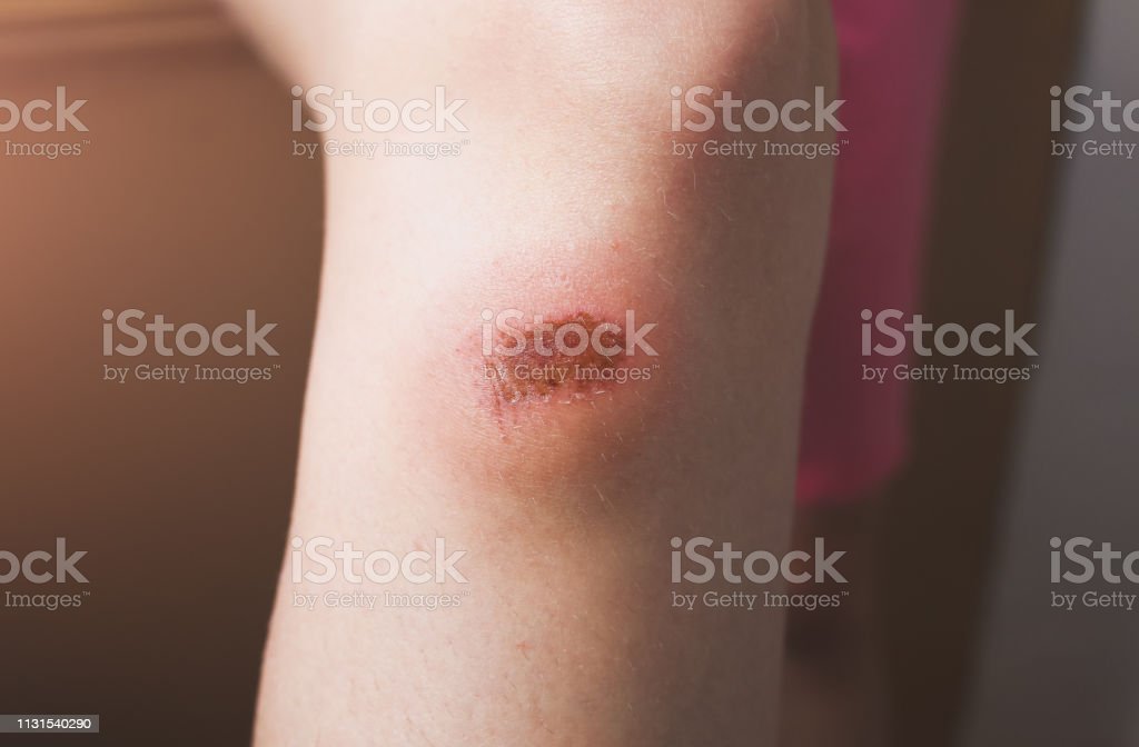 Detail Gambar Luka Di Lutut Wanita Nomer 40