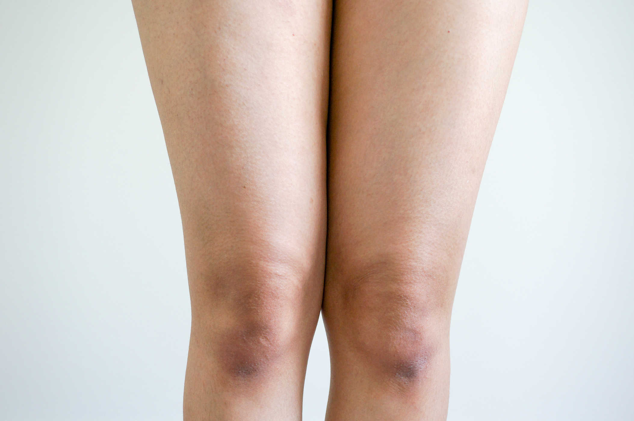 Detail Gambar Luka Di Lutut Wanita Nomer 45