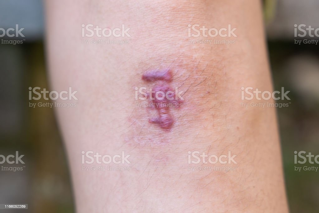Detail Gambar Luka Di Lutut Wanita Nomer 9