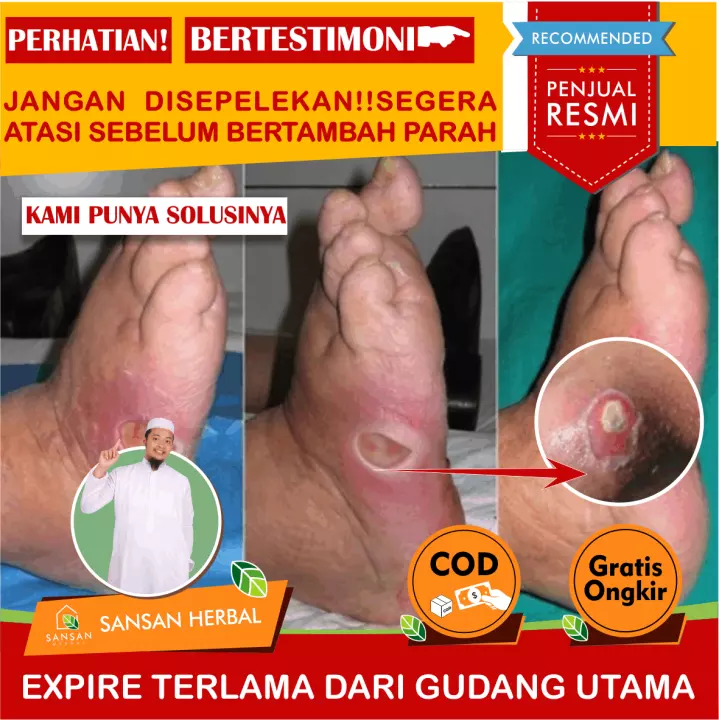 Detail Gambar Luka Infeksi Nomer 32