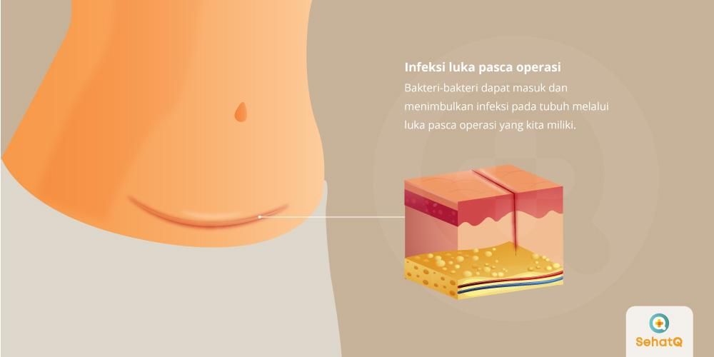 Detail Gambar Luka Infeksi Nomer 48