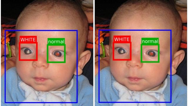 Detail Gambar Mata Bayi Yang Normal Nomer 12