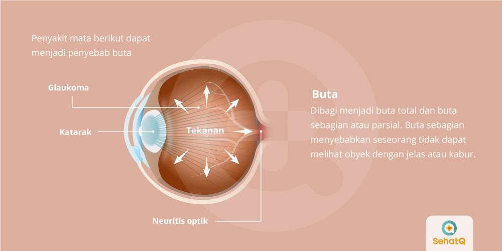 Detail Gambar Mata Buta Nomer 11