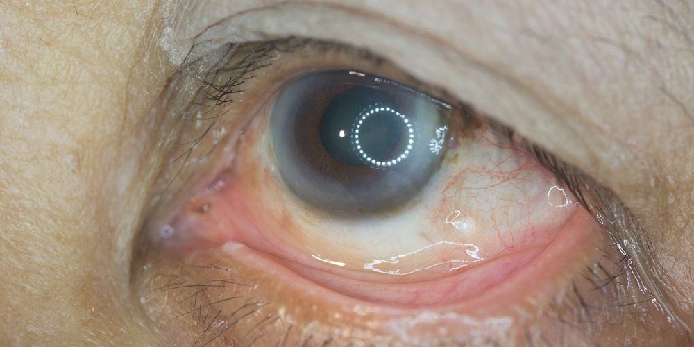 Detail Gambar Mata Glaukoma Nomer 12