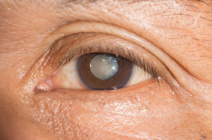 Detail Gambar Mata Glaukoma Nomer 4
