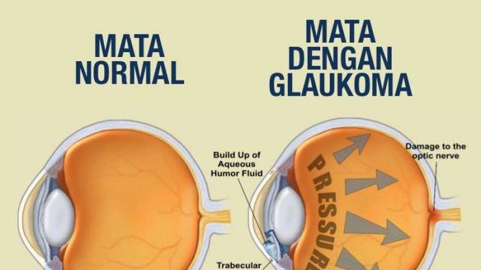 Detail Gambar Mata Glaukoma Nomer 44