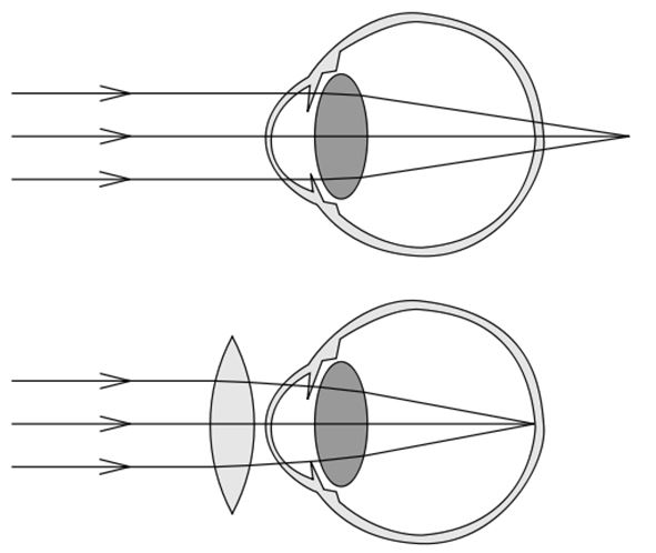 Detail Gambar Mata Hipermetropi Nomer 12