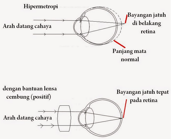 Detail Gambar Mata Hipermetropi Nomer 14