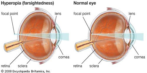 Detail Gambar Mata Hipermetropi Nomer 19